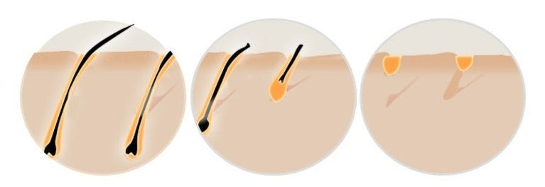 At-Home IPL Laser Hair Removal Device | Safe, Permanent & Painless